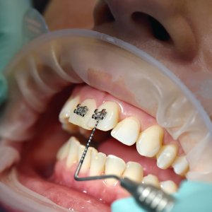 Braces treatment After maxillary expansion
